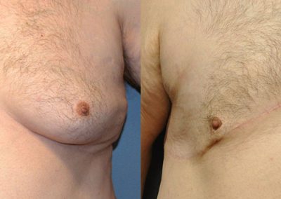 Male Breast Reduction Progression: Before and After Images