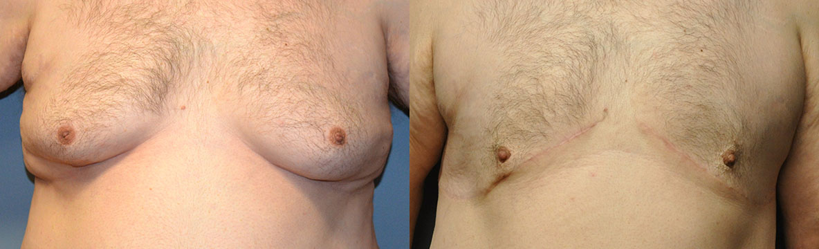 Male Breast Reduction Progression: Before and After Images