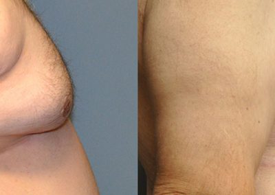 Successful Gynaecomastia Correction: Before and After