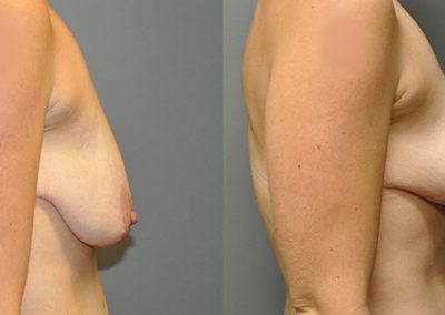 Before and After Mastopexy: Enhancing Female Breast Appearance