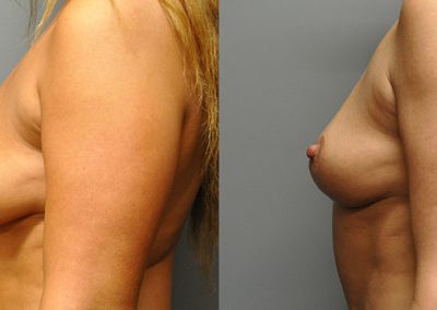 Transformational Mastopexy: Pre and Post-Procedure Breast Photos