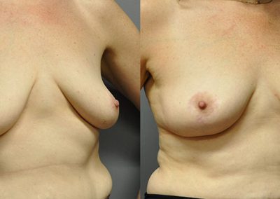 Mastopexy Results: Before and After Images of Female Breasts