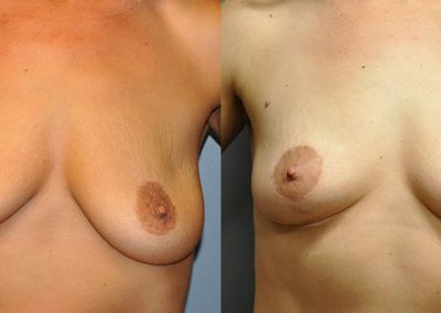 Reshaping Female Breasts: Mastopexy Before and After Images