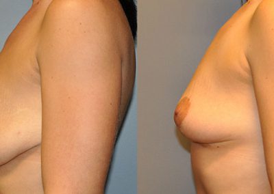 Female Breasts Journey: From Sagging to Perky After Mastopexy