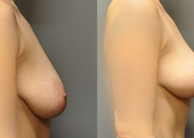 Enhanced Bust: Before and After Mastopexy Procedure
