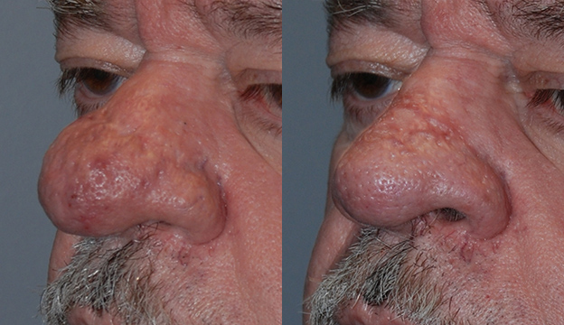 Nose Restoration Journey: Rhinophyma Before and After