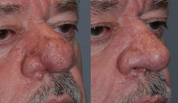 Rhinophyma Resolution: Before and After Photos