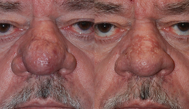 Facial Deformity Correction: Rhinophyma Treatment Results
