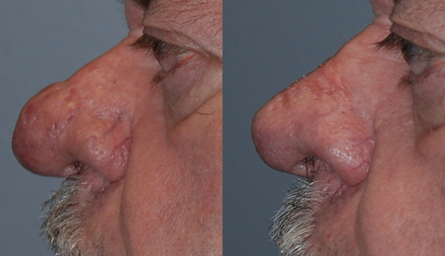 Nasal Reconstruction Progress: Rhinophyma Correction