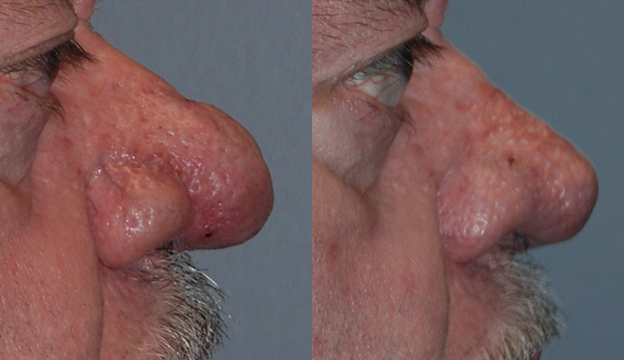 Rhinophyma Transformation: Before and After Treatment