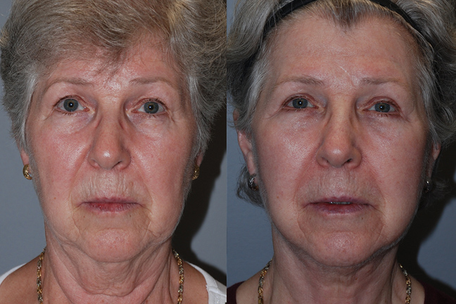 Facial Sculpting Journey: Liposuction Before and After