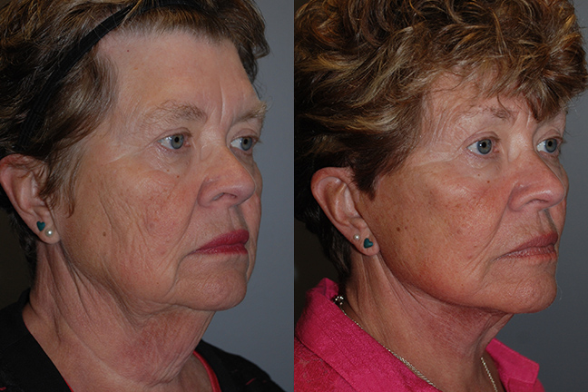 Liposuction Success: Facial Transformation Displayed