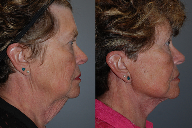 Facial Slimming Progress: Liposuction Transformation Revealed