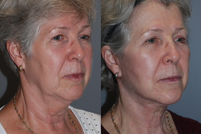 Enhanced Facial Definition: Liposuction Results Comparison
