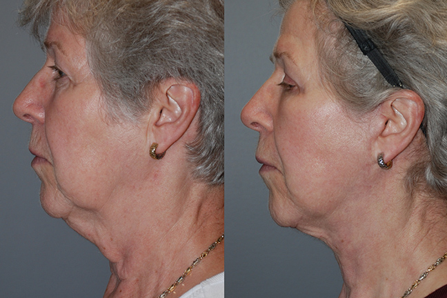 Facial Contour Transformation: Liposuction Before and After