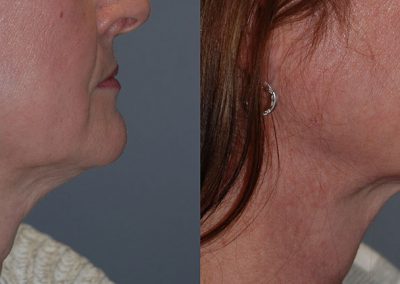 Neck Contour Enhancement: Liposuction Procedure Outcome Displayed