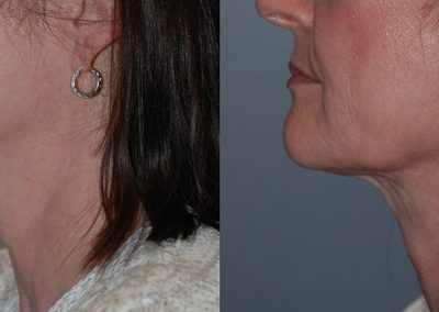 Neck Refinement: Before and After Liposuction Transformation