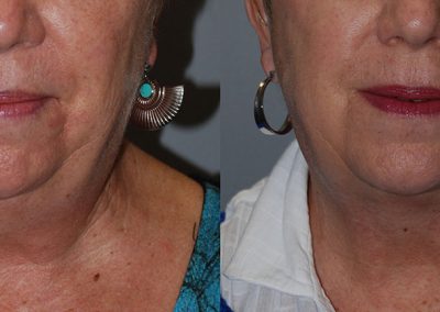 Achieving a Defined Neck: Liposuction Results Revealed