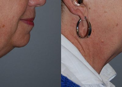 Neck Slimming Progress: Before and After Liposuction Images