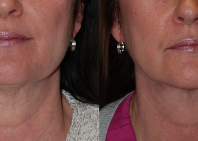 Enhancing Neck Profile: Liposuction Before and After Comparison