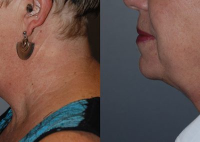 Neck Contouring Journey: Before and After Liposuction Transformation