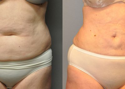 Liposuction Success Story: Before and After Body Images