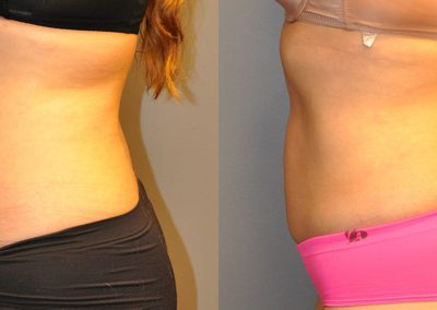 Before and After Liposuction: Enhancing Body Contours