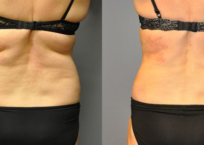 Liposuction Results: Visual Evolution of Body Shape