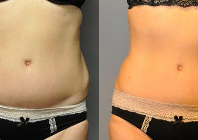 Body Sculpting Journey: Pre and Post Liposuction Comparison