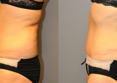 Liposuction Transformation: Before and After Body Contouring