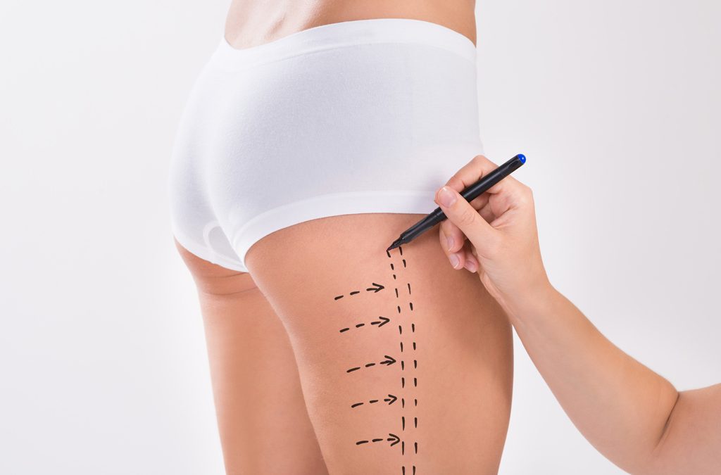 Which Thigh Lift For best result?