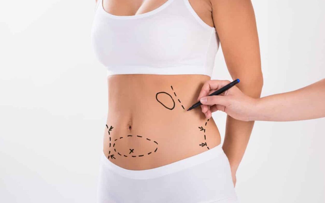 A Realistic Look at Tummy Tuck Scars
