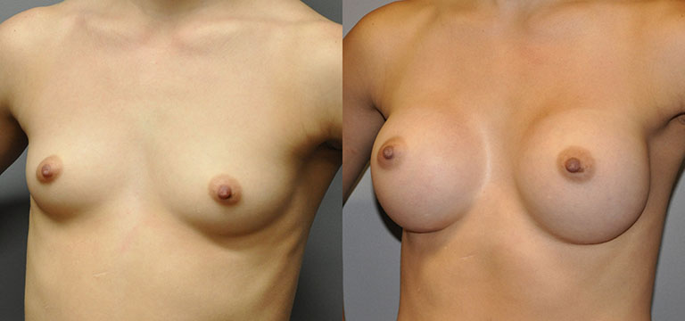 Breast-Augmentation 16