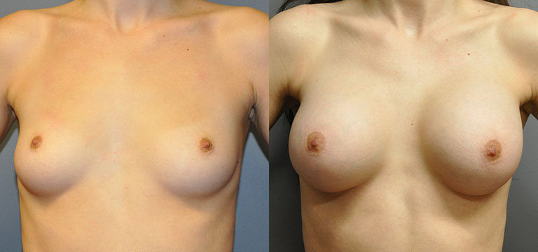 Breast-Augmentation 3