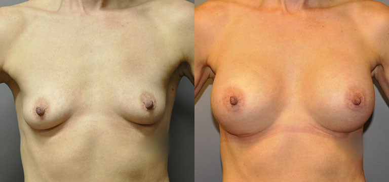 Breast-Augmentation 40