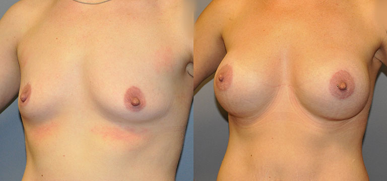 Breast-Augmentation 44
