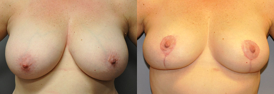 Breast Reduction - Scars shown in these early post-operative images will fade over time