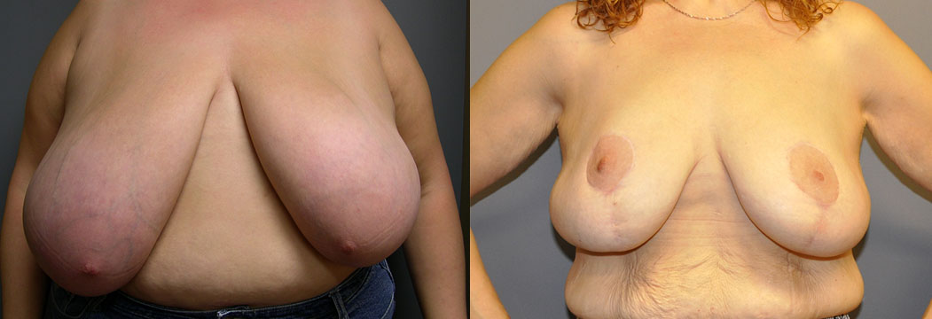 Breast Reduction - Scars shown in these early post-operative images will fade over time