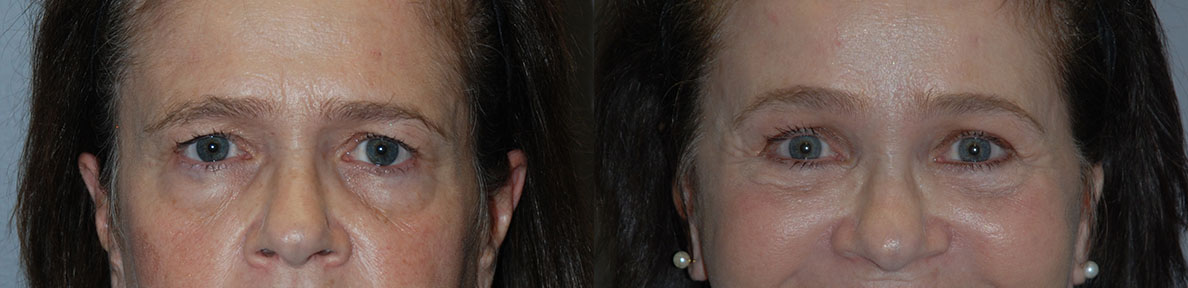 Brow enhancement results: Visual comparison of pre and post-lift