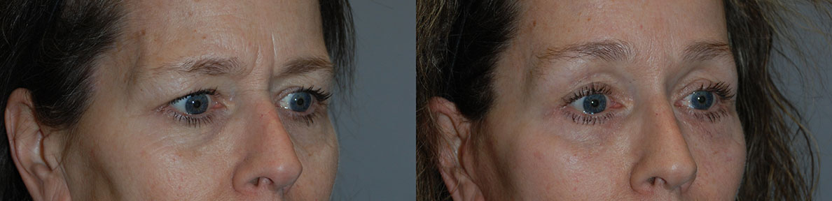 Enhanced brow appearance: Before and after Brow Lift treatment