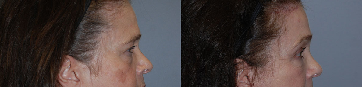Elevated brow position: Before and after Brow Lift procedure