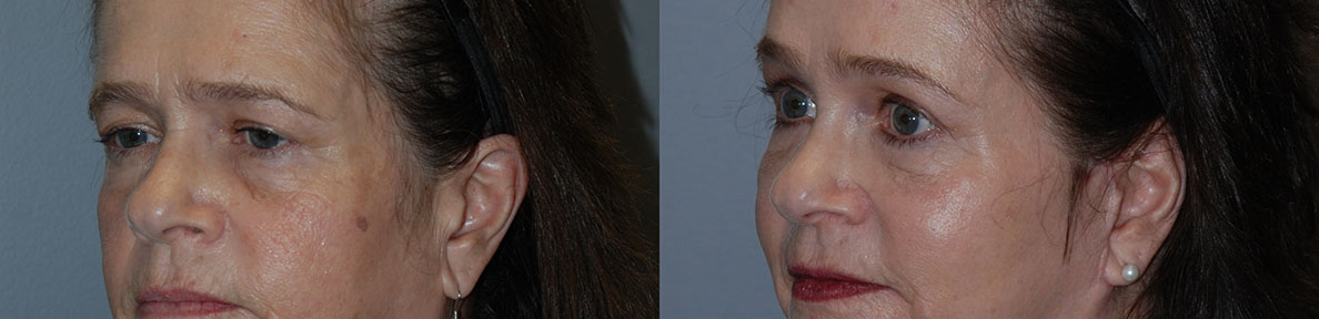 Before and after forehead surgery: Brow Lift's transformative effects