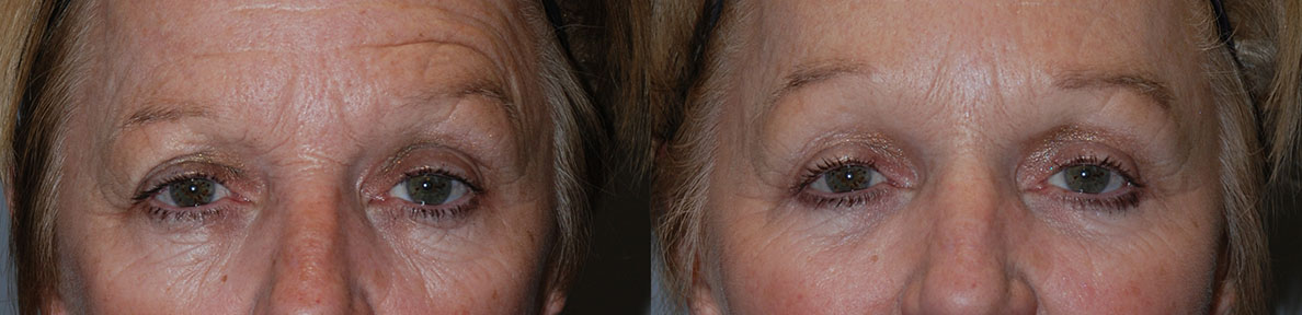 Brow symmetry restoration: Before and after Brow Lift surgery