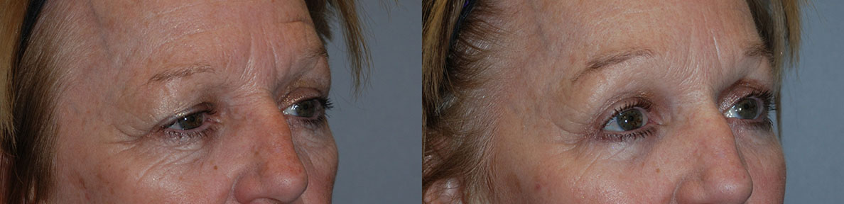 Visible changes in eyebrow position: Brow Lift before and after