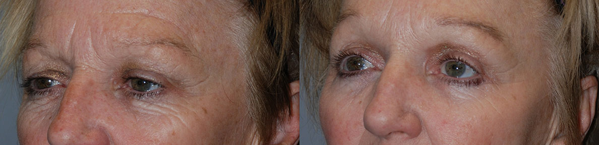 Before and after brow elevation: Brow Lift success
