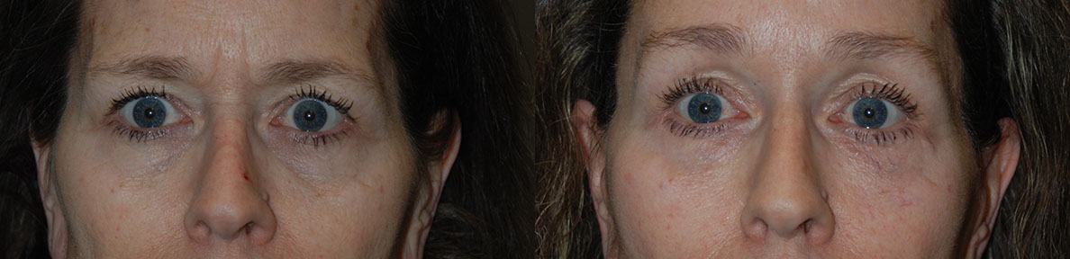 Facial rejuvenation results: Before and after Brow Lift surgery