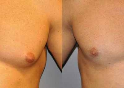 Male breast reduction: Gynaecomastia's transformative effects