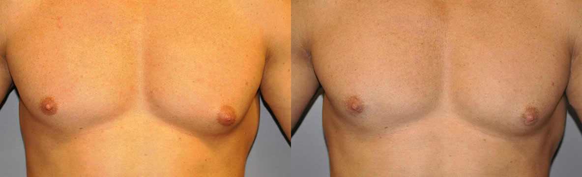 Male breast reduction: Gynaecomastia's transformative effects