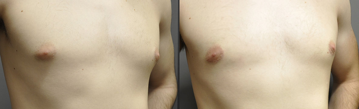 Enhanced chest appearance: Before and after Gynaecomastia correction