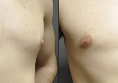 Gynaecomastia transformation: Before and after male breast reduction